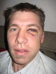 Jordan after the soccer accident