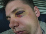 Morning of the surgery before surgery