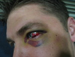 Morning of the surgery - before surgery