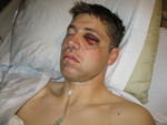 Only hours after the surgery
