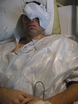 After the surgery with the eye ice pack
