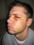 after the surgery