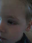 Paul's black eye